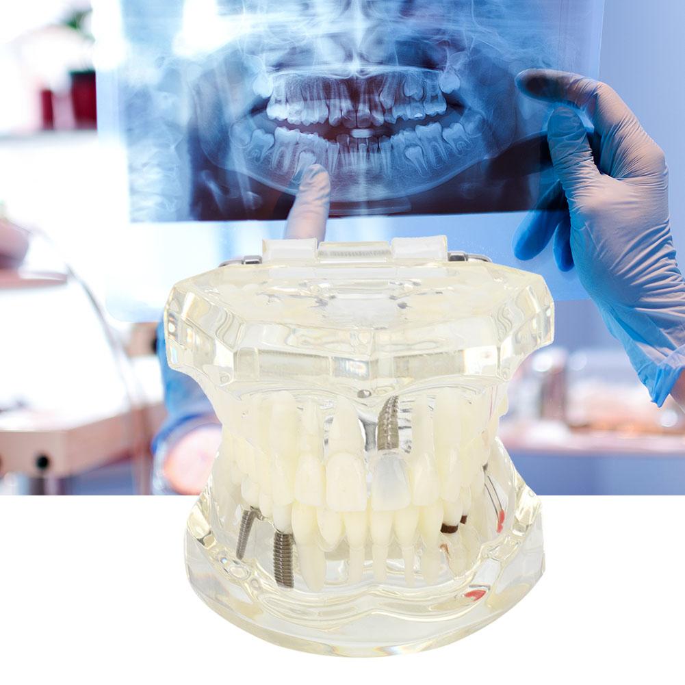 Modello Trasparente di Denti Malati da Laboratorio Studio di Anatomia Patologica Modello Dentale Didattico