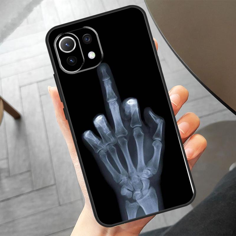 Skeleton Middle Finger Case For Xiaomi 17 15 14 Ultra 13T 14T 15T Pro POCO F8 Ultra X7 Pro X3 X5 X6 F5 F6 F7 Cover