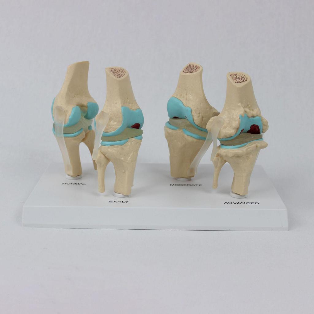 4-Stage Human Knee Evolution Model for Teaching and Display