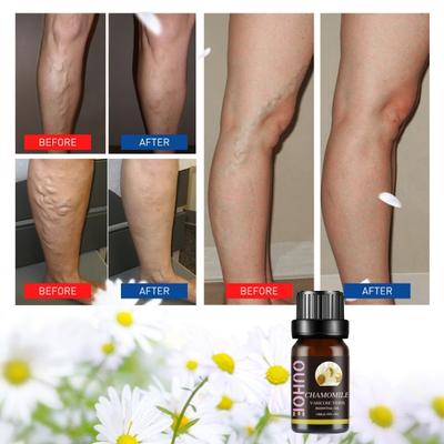 Yousheng 10ML Varis Yağı Şişliği Giderir Bacakları Belirginleştirir Masaj Esansiyel Yağı Daha Pürüzsüz Daha Genç Görünümlü Cilt İçin