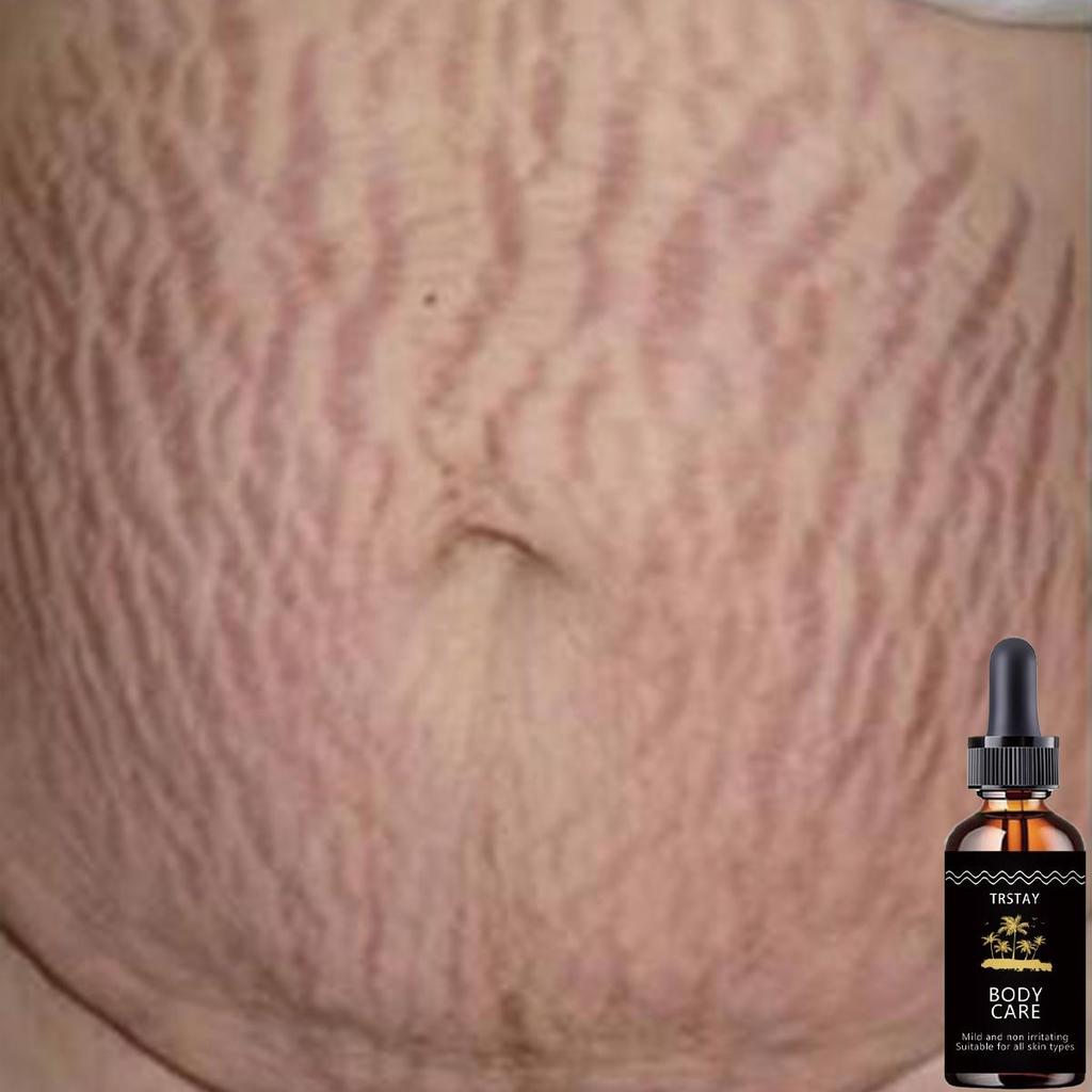 5ML/15ML/30ML/50ML/wheat Skin Stretch Mark Care Essence, Repair the Essence, Moisturize and Moisturize the Skin