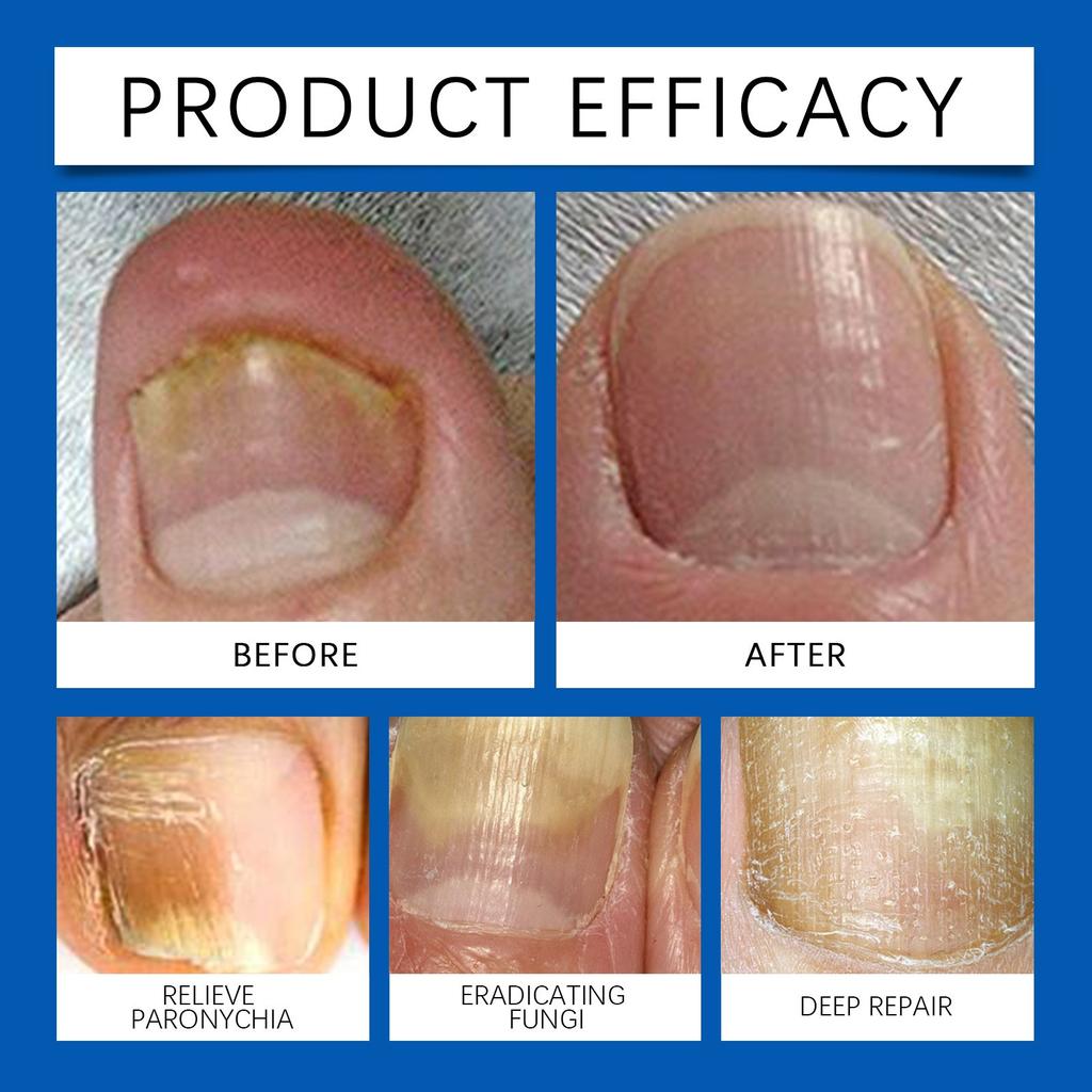 Nail Care Ointment, Moisturizing And Gentle Moisturizing Ointment For Nails