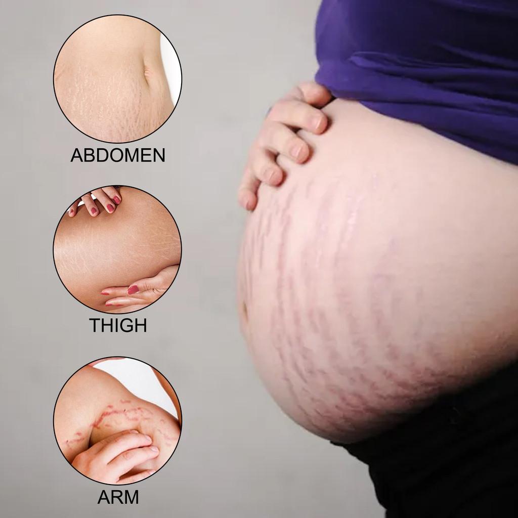 Ouhoe Pregnant Care Cream For Nourishing And Repairing Postpartum Skin Texture And Firmness