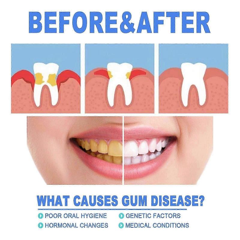 Tandköttsskyddande Reparationsgeler - Lösning för Tandköttshälsa, 4 ml