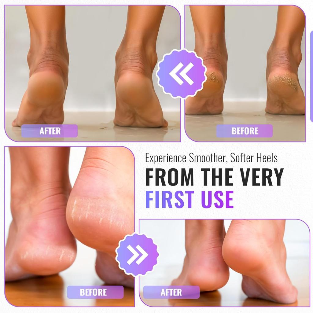1/2pcs 304 Stainless Steel Foot File, Double Sided Callus Remover, Professional Pedicure Tool for Dead Skin & Hard Callus