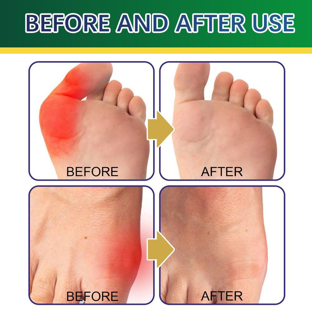 Plant-Based Toe Bunion Patch - Gentle Non-Irritating Post-Activity Relief