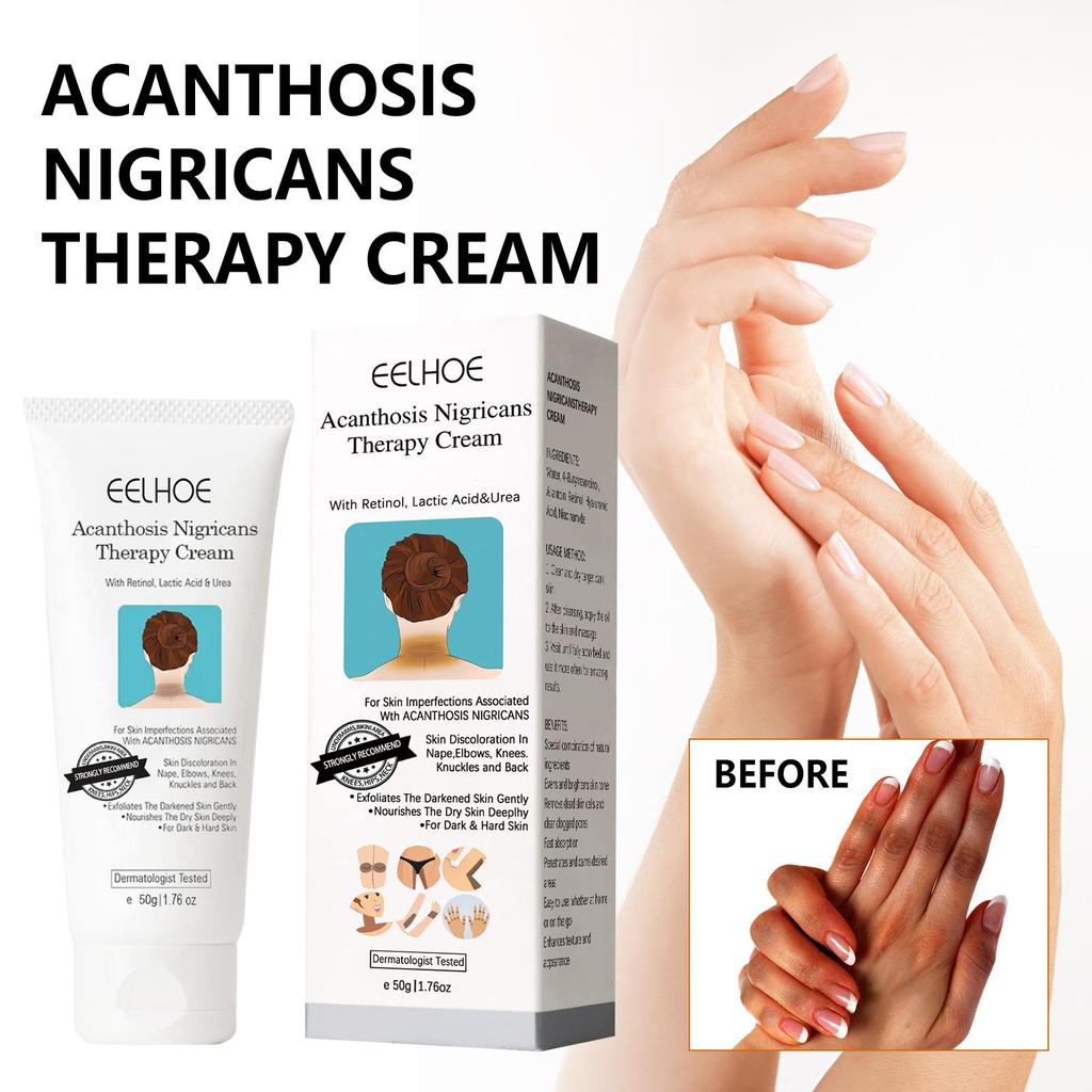 Spot Remover For Body,Spot Corrector Cream,- Underarm, Neck, Armpit, Knees, Elbows, Private Areas, Intimate Areas