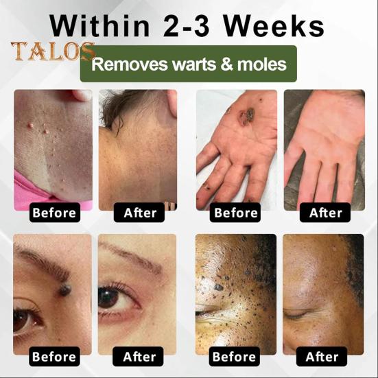 Instant Mole Spot Removal Gel Corrector Cream for All Skin Types Natural Extracts 50g Hydrating Gel Dark Spot Remover for Body Skin Repair Reduces