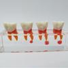 PH4018 Detachable Doctor-Patient Pulp Restoration Pathology Teaching Model
