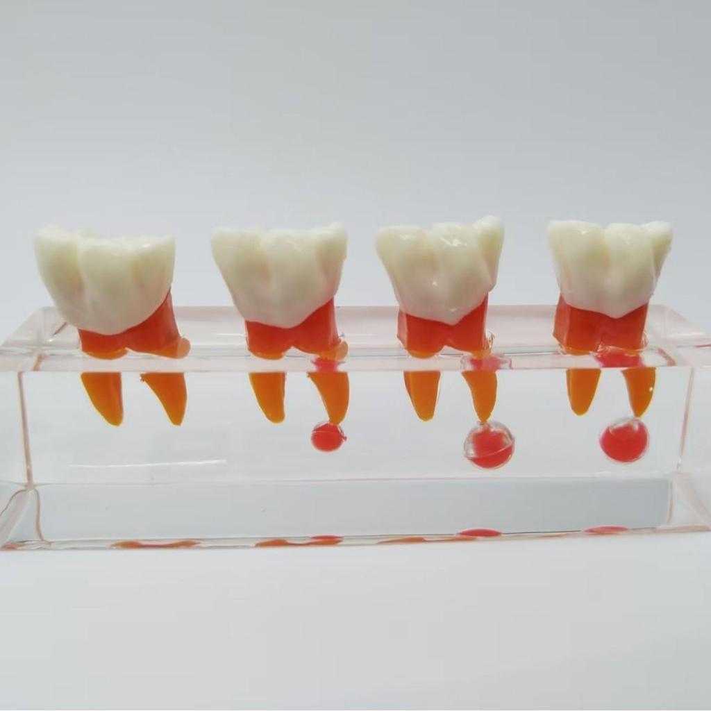PH4018 Detachable Doctor-Patient Pulp Restoration Pathology Teaching Model
