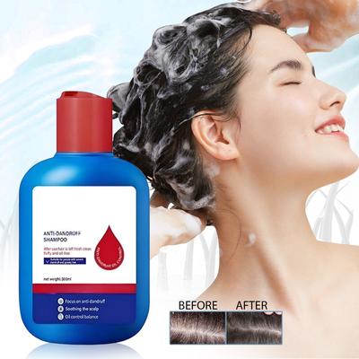 Shampoo, Selensulfid-Shampoo, Ölkontroll-Shampoo Reduziert überschüssiges Öl Ölkontrolle für Männer und Frauen Erfrischend, 120 ml