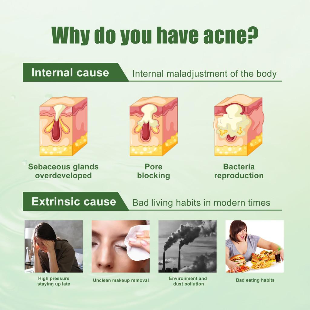 South Moon Acne Gel For Clear And Radiant Skin 30ml Blemish Reducing Formula