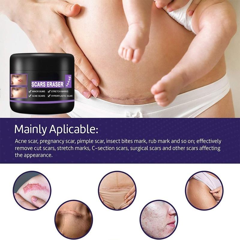 Scar Repair Cream Desalt Postoperative Scars, Smooth Skin, Repair Skin Wounds, Moisturize Skin Care Cream