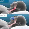 Honex Snoring Mouth Guard, Stop Snoring Aid for Better Sleep, Men Women Comfort Fit