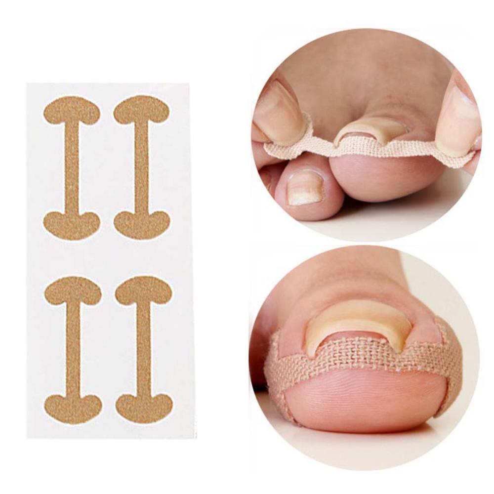 Zehennagelkorrektur für Pflege Zehennagelbehandlung Aufkleber Korrektur Erholungspflaster Fußeinlagen