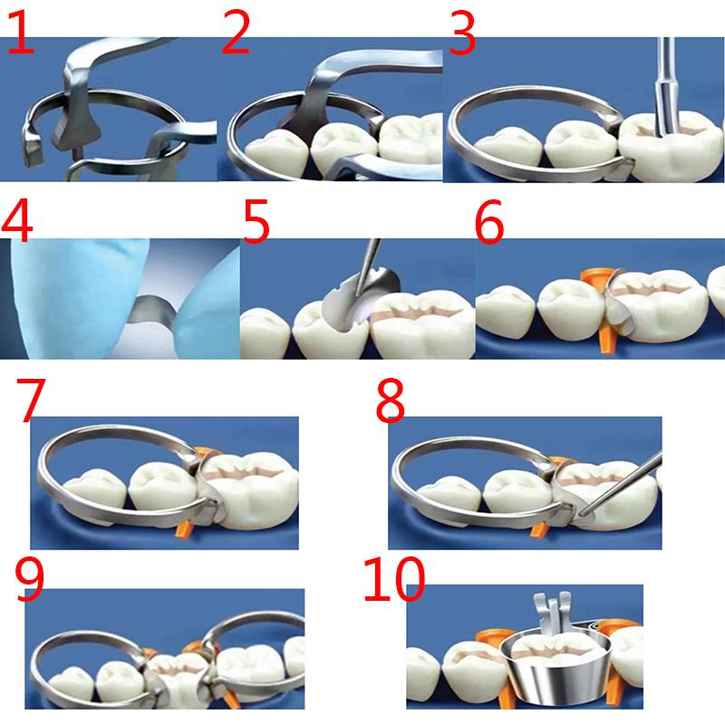 100Pcs Dental Matrix Sectional Contoured Metal Matrices No.1.398 Lmws 2 Rings