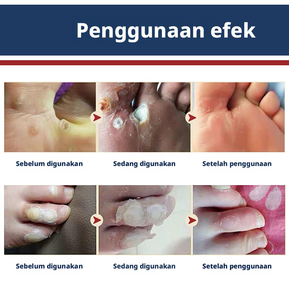 24PCS/box Corn Patch Corn Plaster Remover Corn Toe Pads Patch Adhesive Callus Cushion Non-woven Fabric Toe Corn Callus Removal