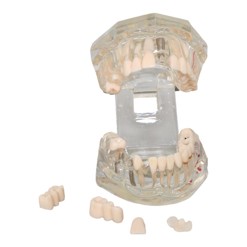 Dental Implant Teaching Model & Toothbrush Preparation Resin Mold