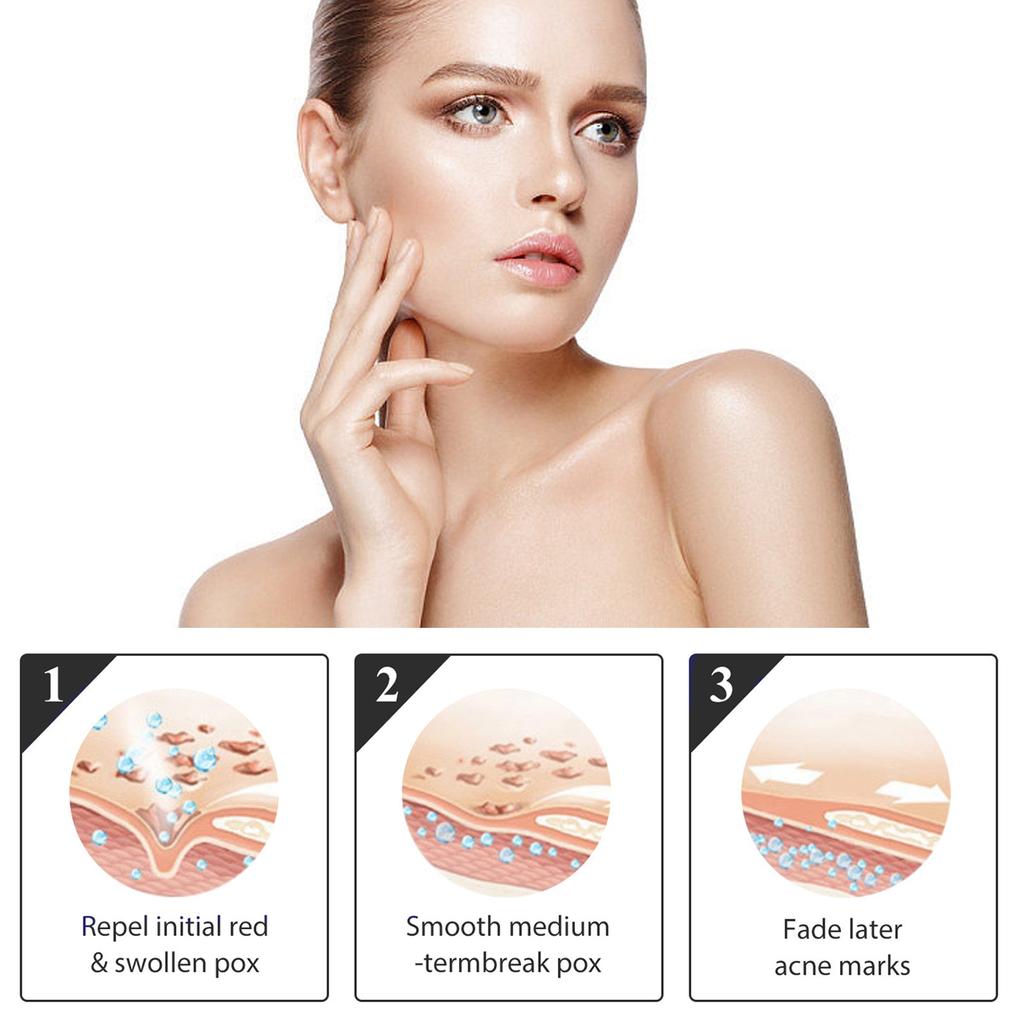 Acne Cream, Facial Cleansing And Acne Cleansing Cream, Gentle Acne Removing And Brightening Facial Skin Care Cream