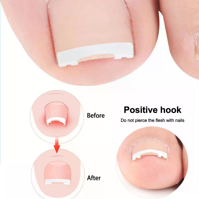 1PCS Ingrown Toenail Corrector Tools Pedicure Recover Embed Toe Nail Treatment Professional Ingrown Toenail Correction Foot Care