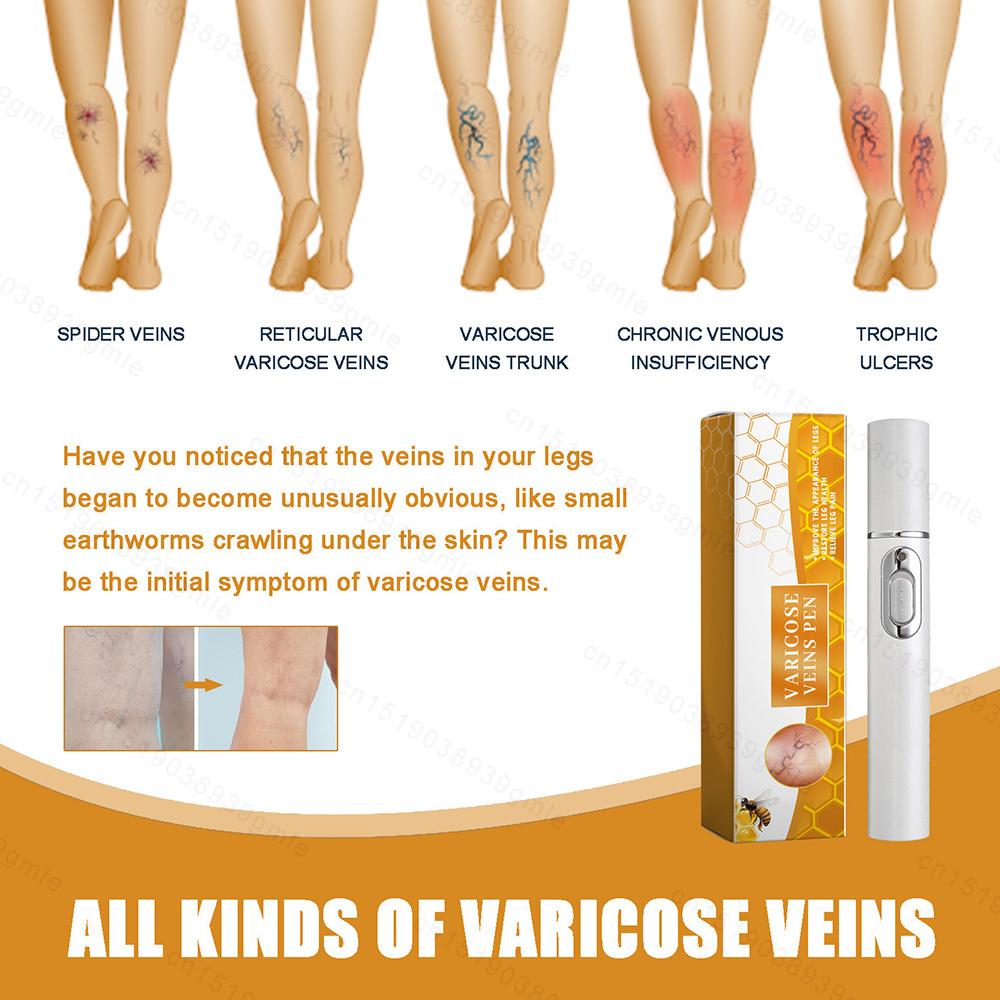 Upgrade Varicose Veins Laser Pen, Spider Vein and Leg Blood Painless Treatment With,Medical Grade 980Nm Infrared Therapy Device