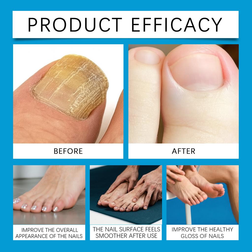 Nagelpflegespray, Nagelpflege, Zehennagelflüssigkeit, Weiche Nagelverdickungscreme, Nagelpolitur Aufhellungs-Spezial, Eingewachsener Nagel Granulationspflege, 100ML