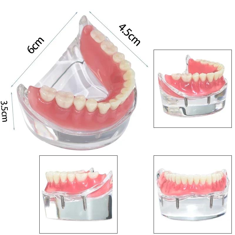 Modello Denti Dentali Trasparente 4 Impianti Overdenture Ponte Rimovibile Modello Mandibolare Inferiore M6003 Materiali per Studio Dentistico