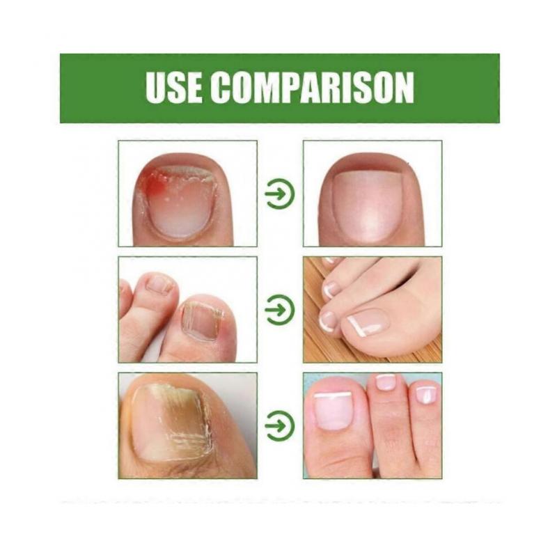 (1 st)1-3X Nail shield ANTI-FUNGAL STICK Nailshield Anti Fungal Stick, Monsalife Nail Shield Anti Fungal Stick