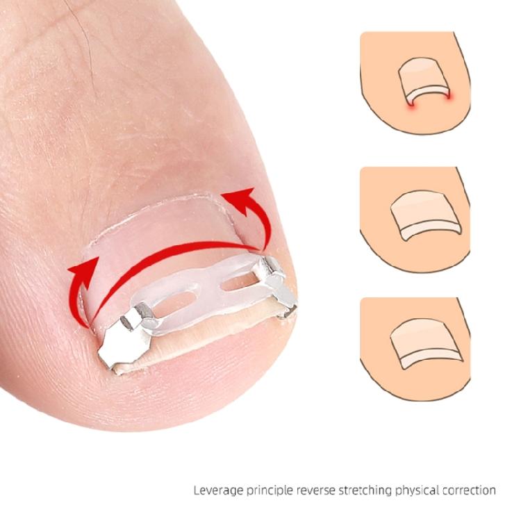 Stainless Steel Lever Hook Ingrowns Toenail Tool Elastic Bands Adjustable Corrector For Men And Women