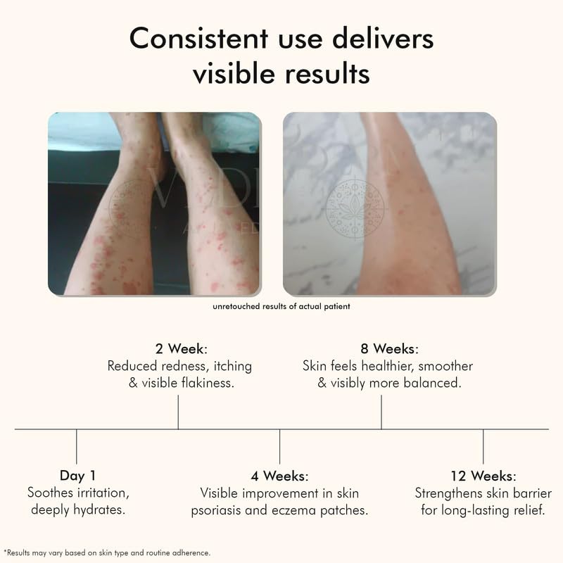 Psoréa Cream with 2% Bakuchi Extract Skin Barrier Repair | Itching and Dryness Control |  (200ml, Pack of 1)