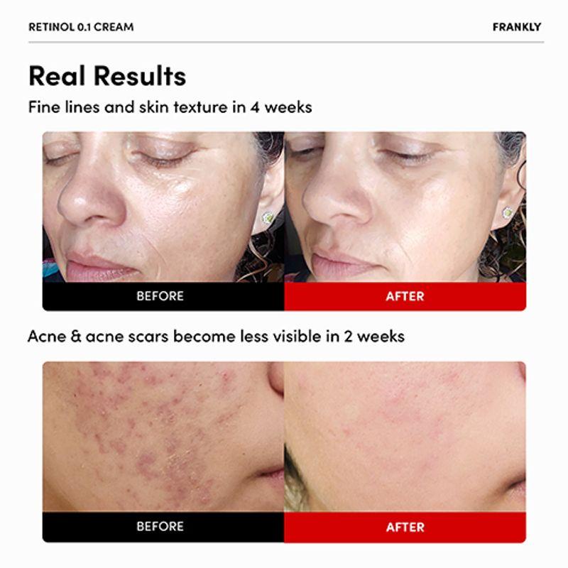 [FRANKLY] Retinol 0.3% cream 20ml