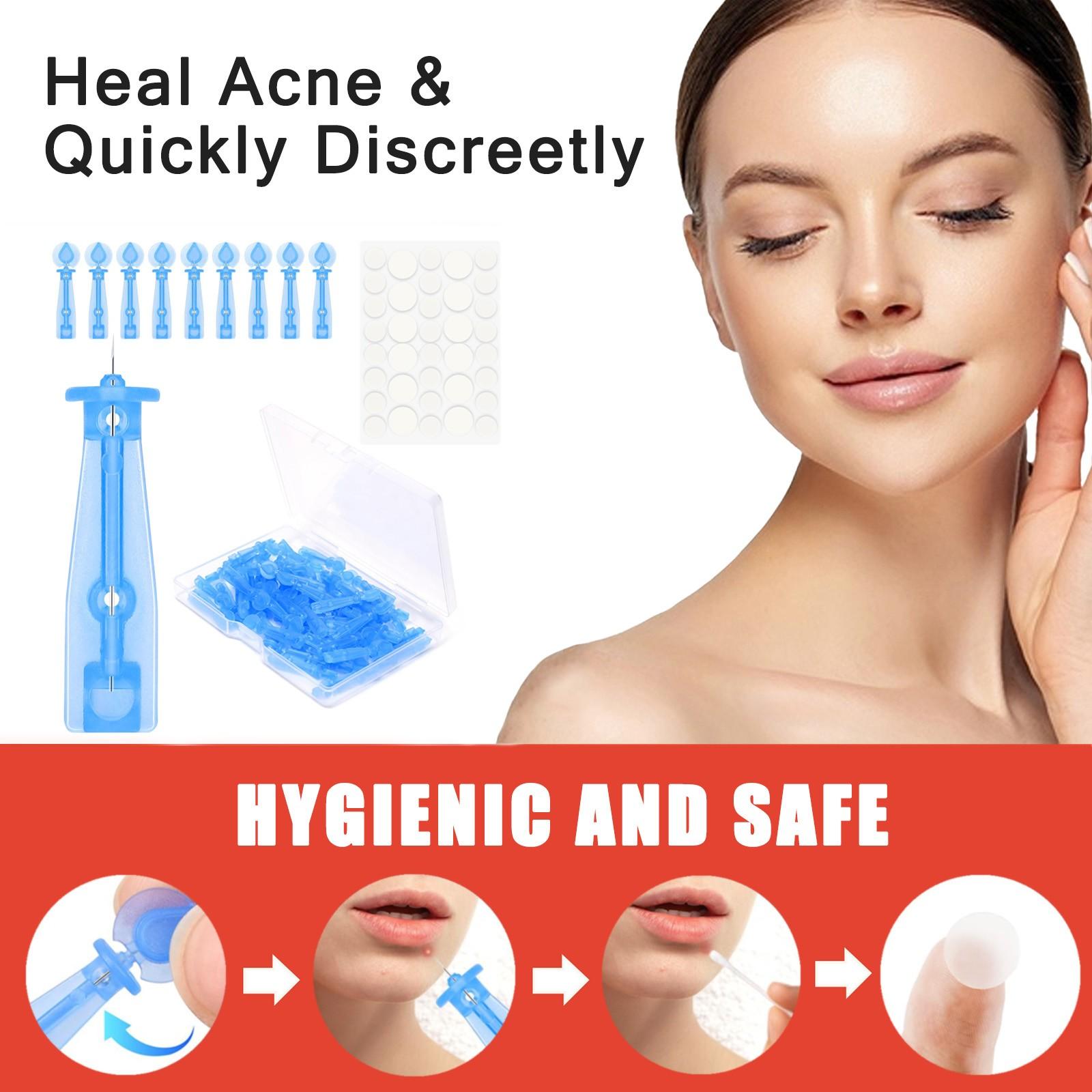 

Набор стерильных игл от прыщей, эффективно удаляет прыщи