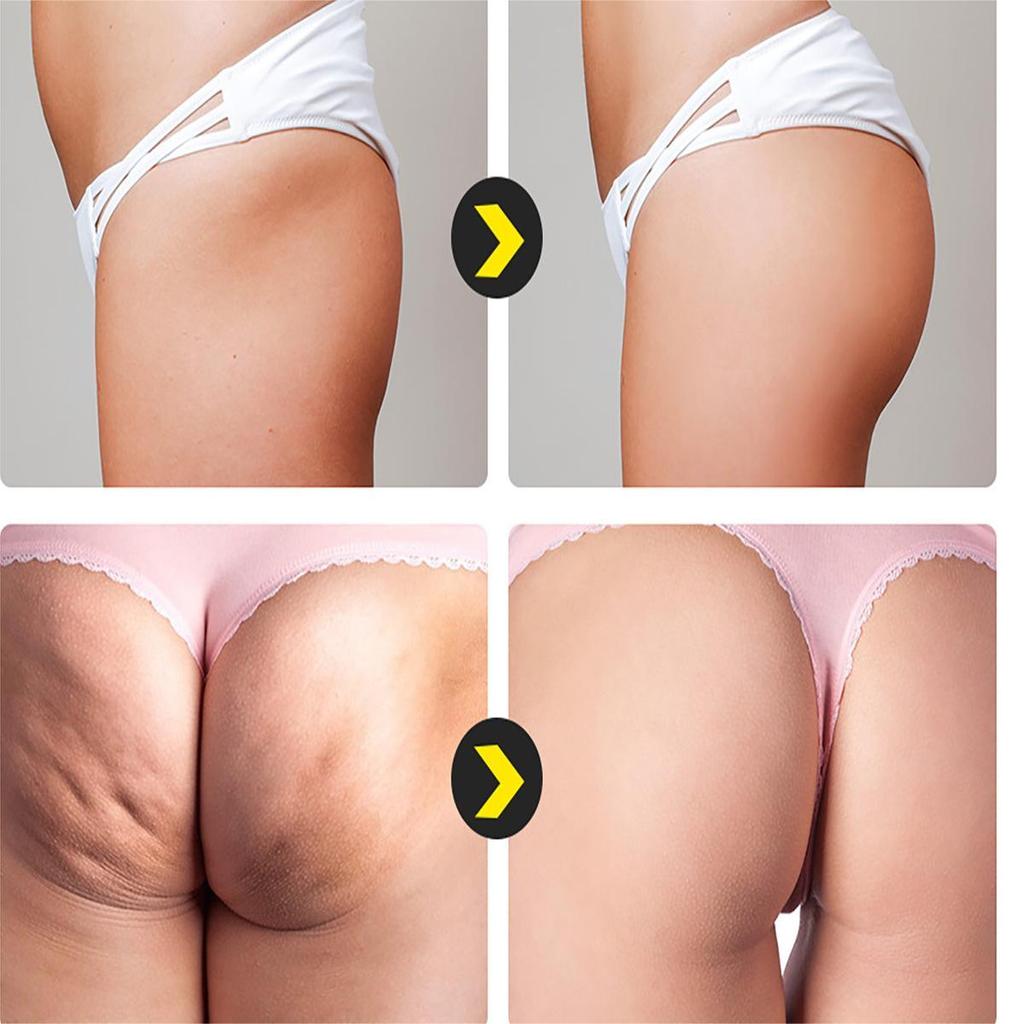 Bělící masážní krém obnovuje elasticitu pokožky, rozjasňuje a vyživuje pokožku a vypíná hýždě krémem