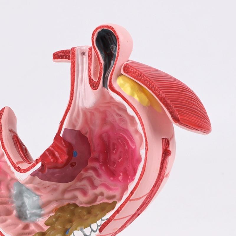 Diseased Stomach Model Stomach Anatomy Model Pathological Stomach Model For Medicals Students And Healthcare Learning