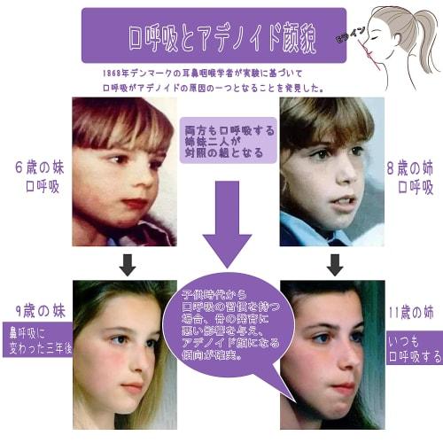 Mouth-Closing Tape, Prevents Mouth Breathing, Nasal Breathing Tape, Prevents Adenoid Face, Prevents Dry Throat, Promotes Nasal Breathing, Improves Sle