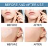 240Pcs Large Acne Patch Pimple Hydrocolloid Stickers Spot Cover Remover Treatment
