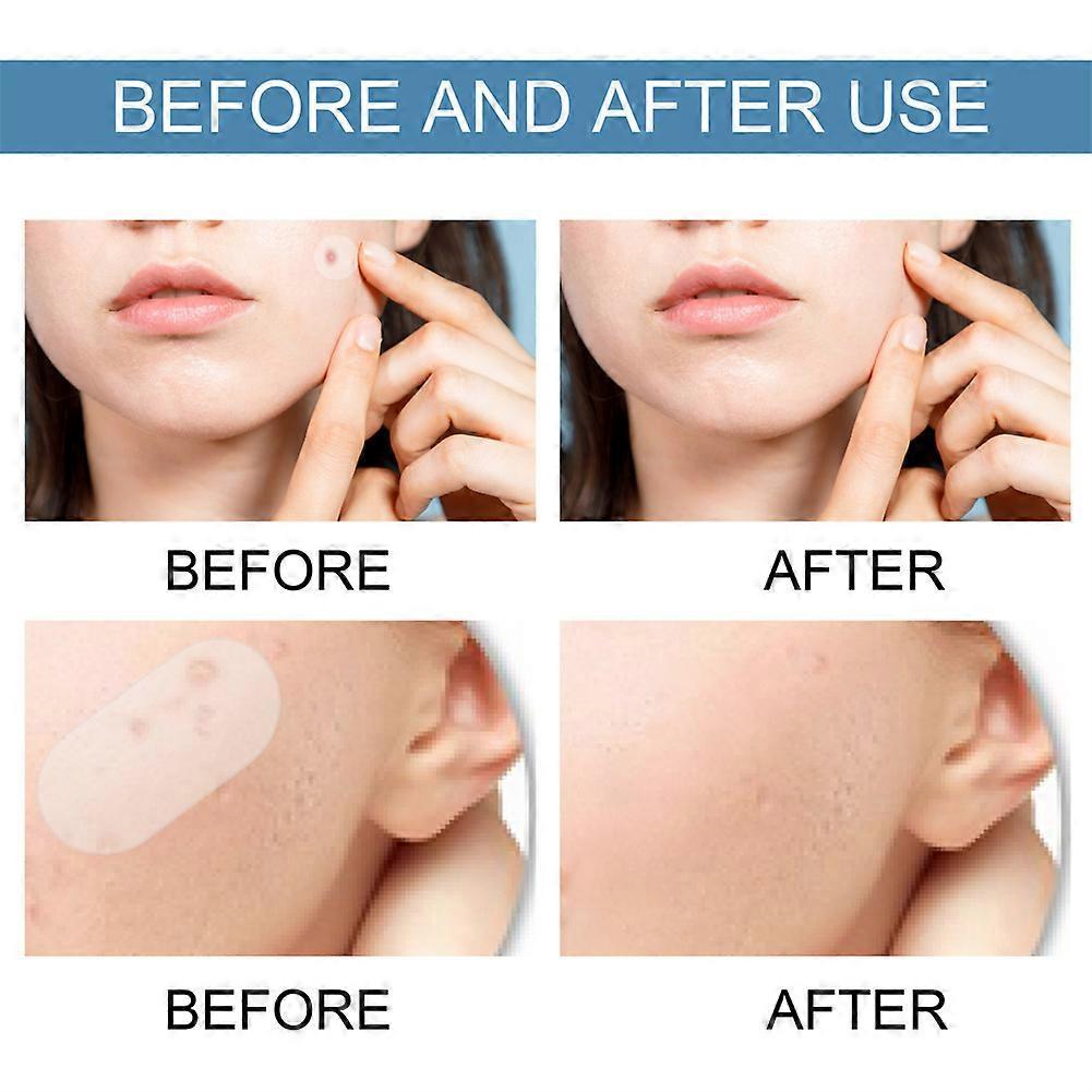 240Pcs Large Acne Patch Pimple Hydrocolloid Stickers Spot Cover Remover Treatment