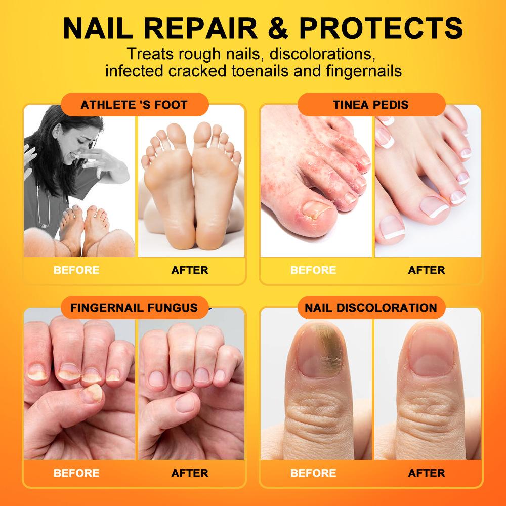 Sumifun 60/120/300ML Bee Foot Care Spray Relieve Beriberi Foot Odor Nail Antibacterial Onychomycosis Repair Spray Summer Essential