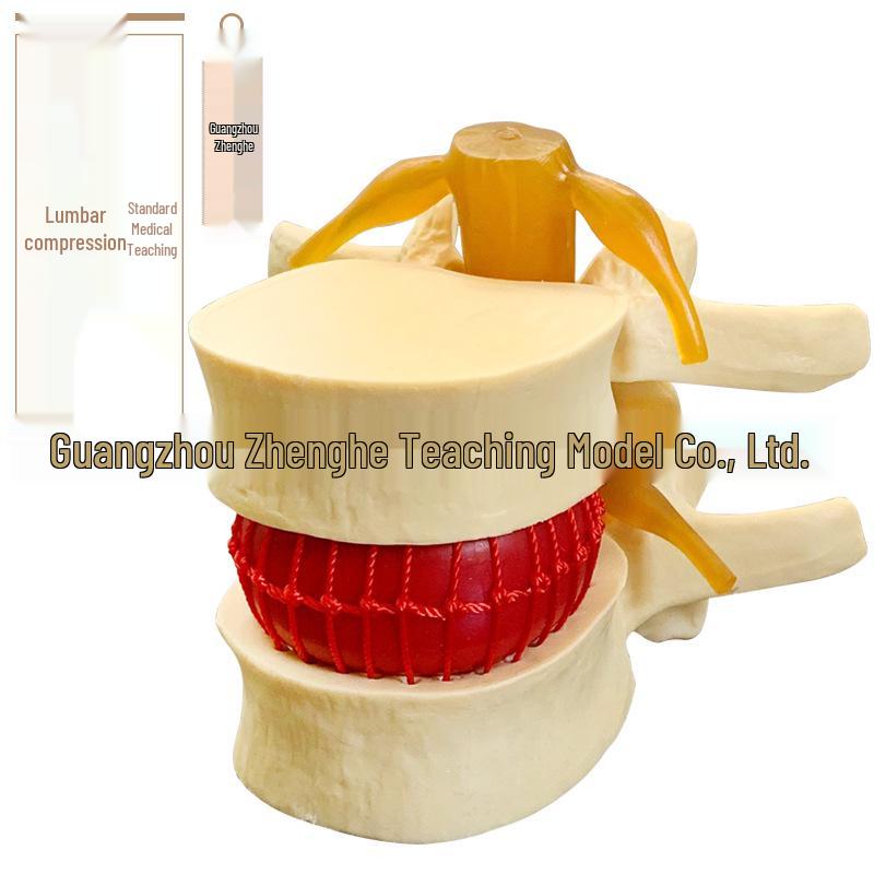 Medical Lumbar Disc Herniation Model: Spine & Joint Pathology with Lateral Compression