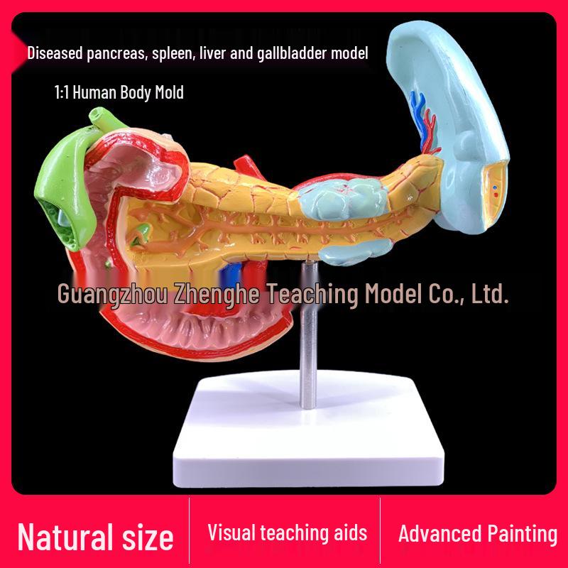 Anatomical Model: Pancreas, Spleen, Liver, Gallbladder & Duodenum with Pathological Pancreas. 19 x 15 x 23 cm