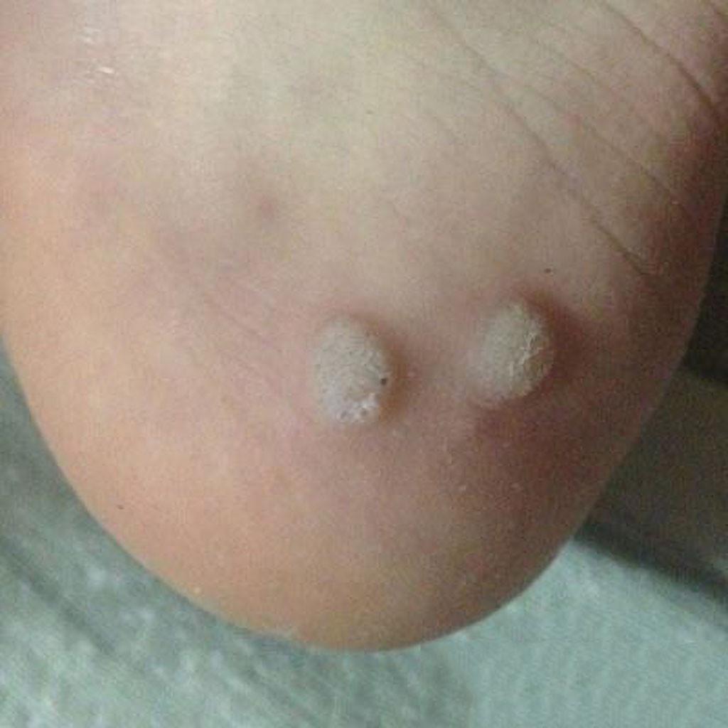 Foot Corn Remover Plaster Foot Pad Patches  Patch Pain Foot Care Tools