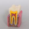Modello Carie Dentale 6 Volte Malattia Denti Modello Dentale per Dimostrazione Dentale Modello Insegnamento Dentista Laboratorio Dentale Ricerca Orale