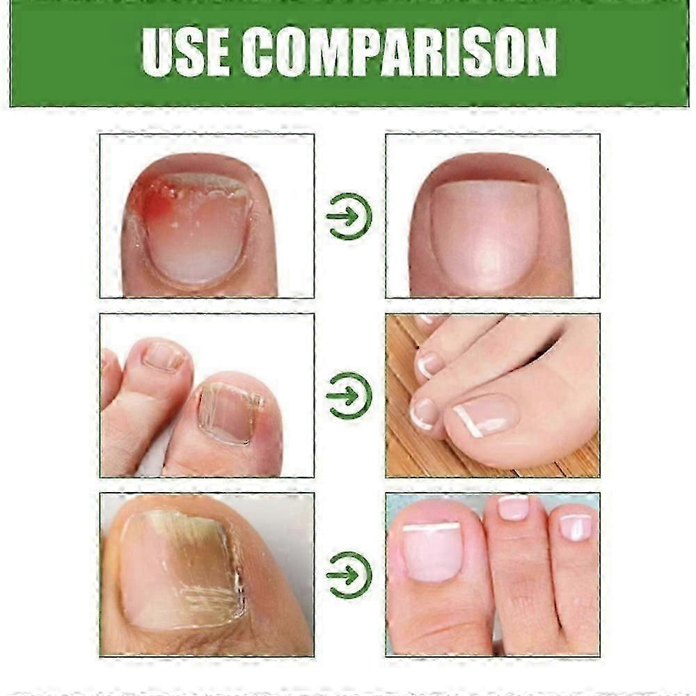 Monsalife Antifungální štít na nehty v tyčince, 1-3x Antifungální ochrana, Složení proti přichycení, Péče o nehty pro prevenci plísňové infekce