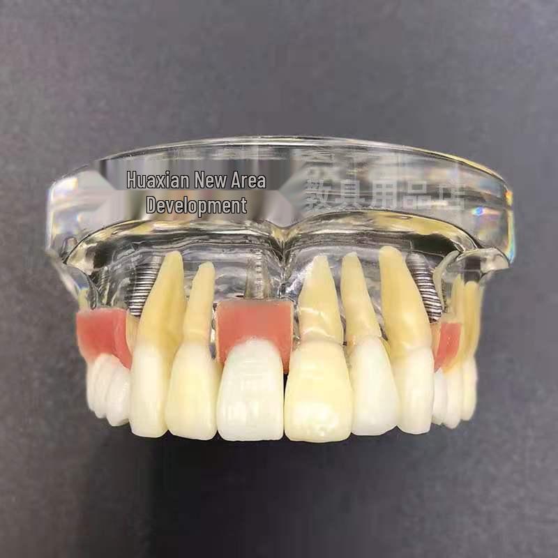 Dental Implant Model: Half-Mouth with Fixture, Abutment, Soft Gum, Crown, Bridge Restoration 2005
