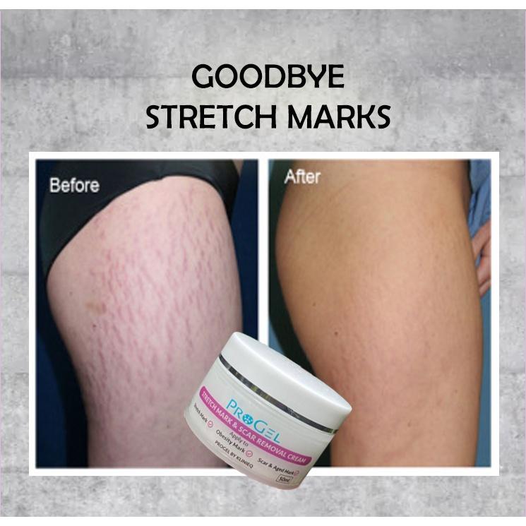 

Удалить растяжки, целлюлит и шрамы