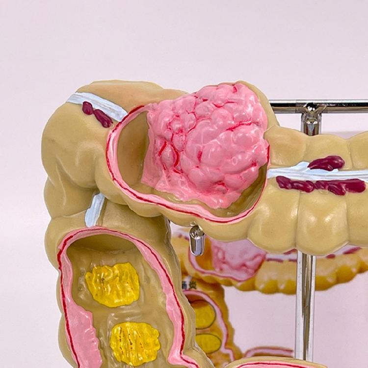 Pathologien des Dickdarms beim Menschen Modell Medizinisches Lehrmittel Modell des menschlichen Dickdarms Modell der menschlichen Anatomie