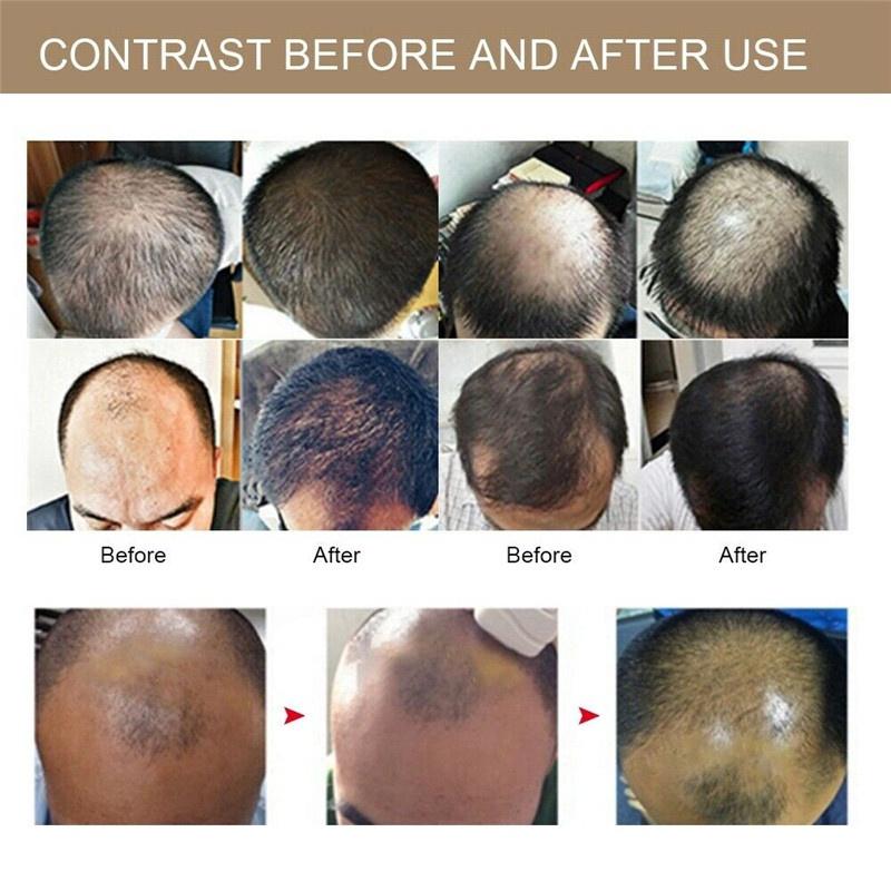 Laser Hair Regrowth Laser Helmet Men Hair Growth Cap Helmet Hair Loss Laser Treatment Hair Fast Growth Anti Hair Loss