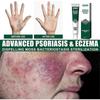 1-5x Ringworm Treatment - Ringworm Cream- Relieves Itching - Cream Antimicrobial and Antifungal- Fast Acting Tinea Itch Relief,20g