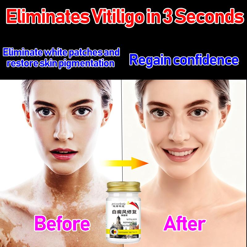 

Vitiligo ointment special ointment for white spot skin disease