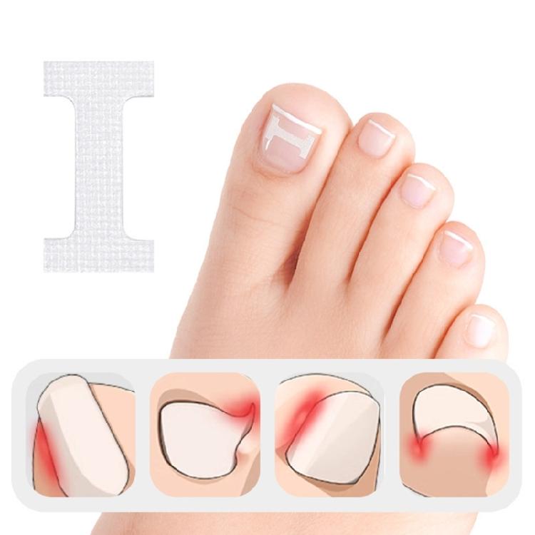 Ingrown Toenail Corrector Patches,Ingrown Toenail Treatments Tool Foot Care,10pcs Ingrown Toenail Corrector Strips